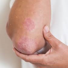 Psoriasis Treatment in Navi Mumbai