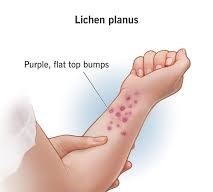 Lichen Treatment in Navi Mumbai