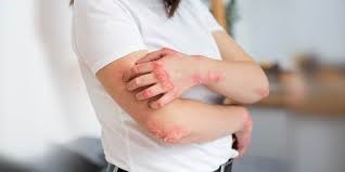 Skin Fungal Infection